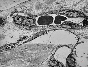 F,42y. | pseudoangiomatous hyperplasia